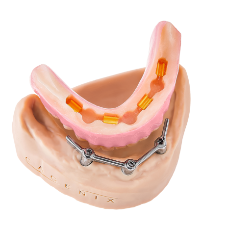 AccuFrame Overdenture Hero